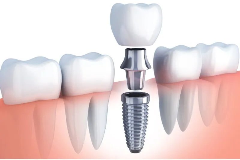 dental-implants