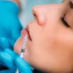 dermal fillers lips