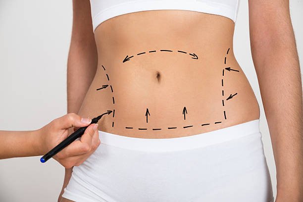 Liposuction in Al Ain