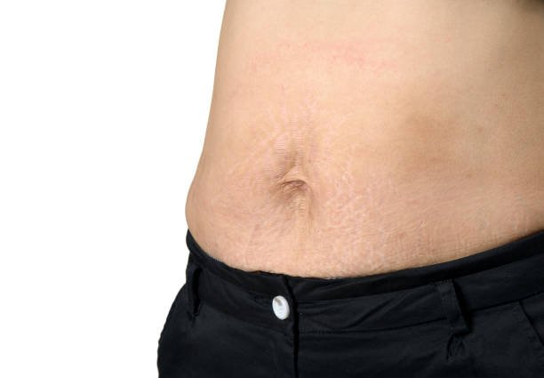 High-definition liposculpture in Abu Dhabi