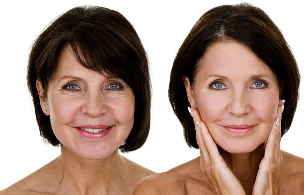 Non-Surgical Facelift in Abu Dhabi