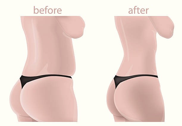 Buttock Augmentation in Abu Dhabi