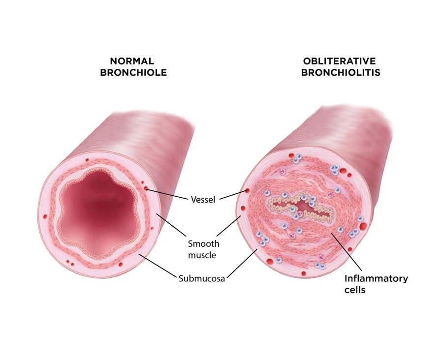 Bronchiolitis Obliterans Syndrome