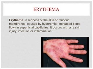 Erythema