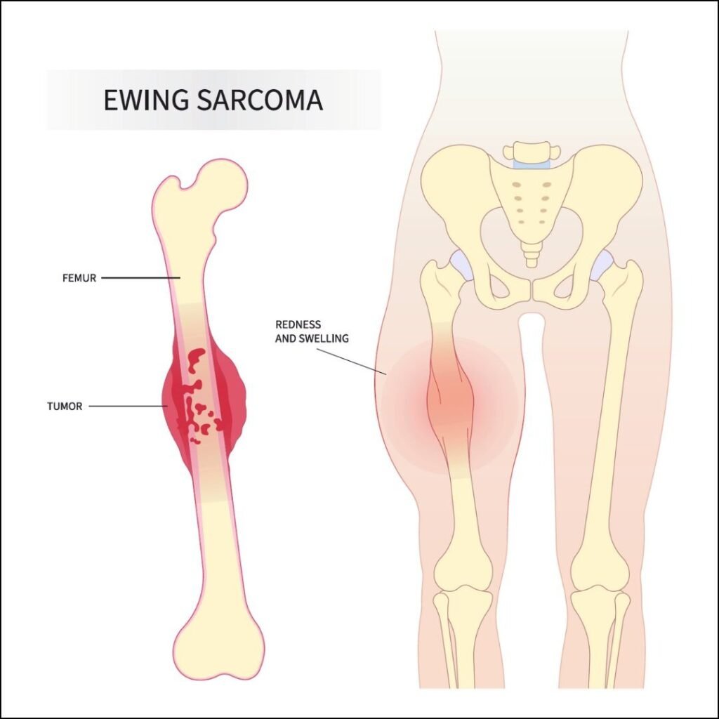 Ewing’s Sarcoma