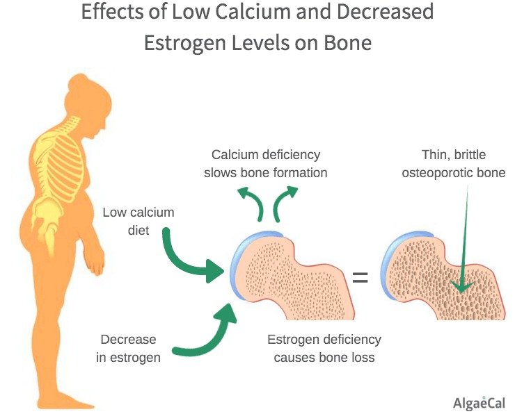 Post Menopausal Osteoporosis