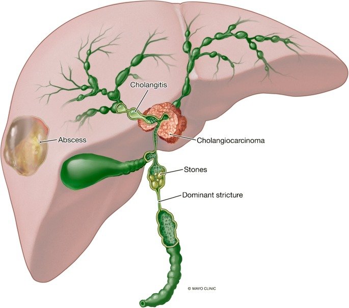 Primary Sclerosing Cholangitis.