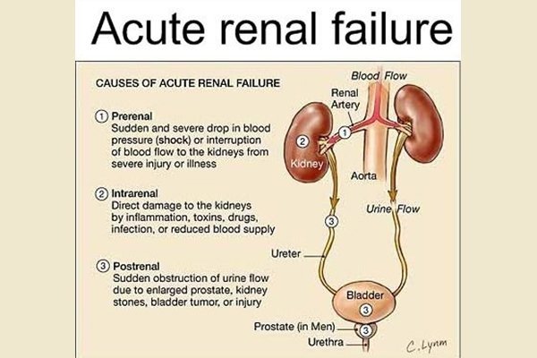 Acute Renal Failure