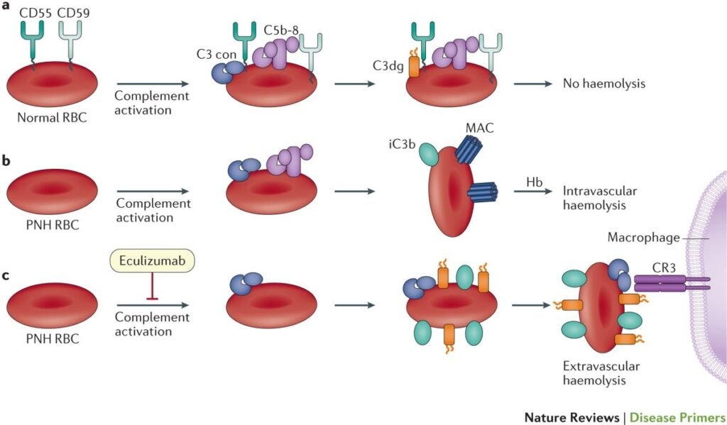 Paroxysmal Nocturnal Hemoglobinuria