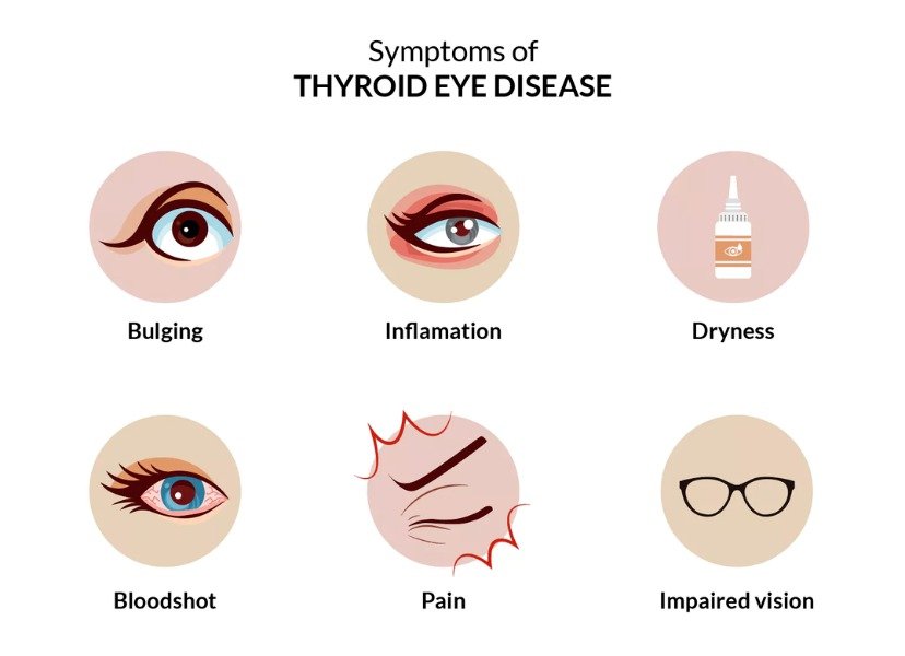 Thyroid Eye Disease